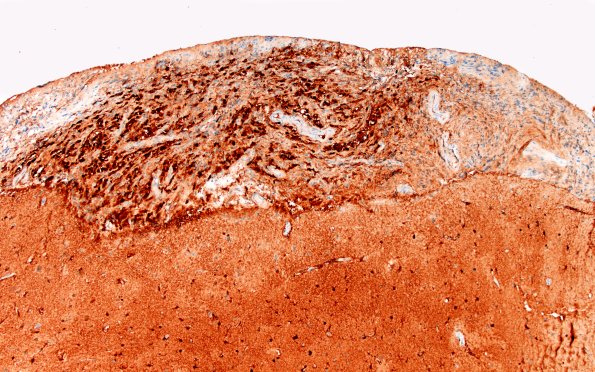 1D2 Diffuse leptomeningeal glioneuronal tumor (Case 1) S100 10X 1