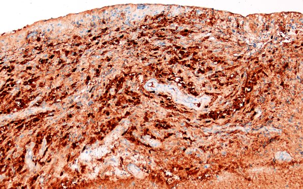 1D3 Diffuse leptomeningeal glioneuronal tumor (Case 1) S100 20X 2