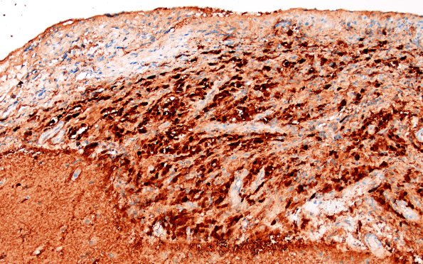 1D4 Diffuse leptomeningeal glioneuronal tumor (Case 1) S100 20X 1