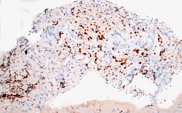 1E3 Diffuse leptomeningeal glioneuronal tumor (Case 1) Olig2 20X 1