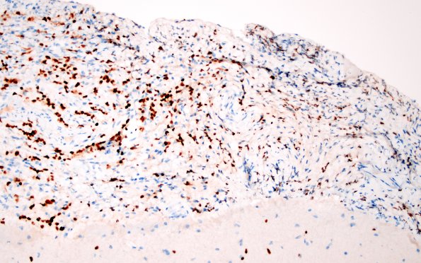 1E4 Diffuse leptomeningeal glioneuronal tumor (Case 1) Olig2 20X 2