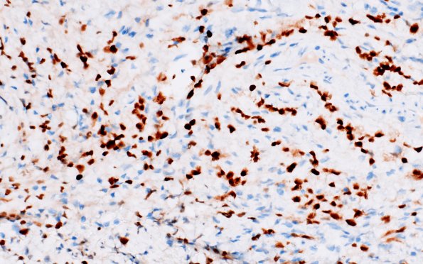 1E6 Diffuse leptomeningeal glioneuronal tumor (Case 1) Olig2 40X 1