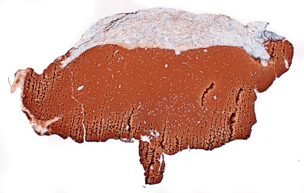 1F1 Diffuse leptomeningeal glioneuronal tumor (Case 1) Synaptophysin 4X 1