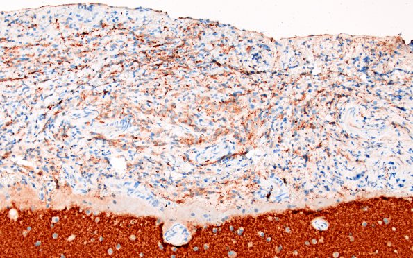 1F3 Diffuse leptomeningeal glioneuronal tumor (Case 1) Synaptophysin 20X 2