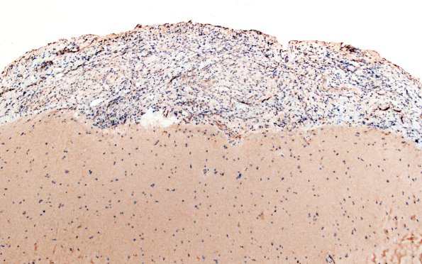 1G2 Diffuse leptomeningeal glioneuronal tumor (Case 1) IDH1 10X 1