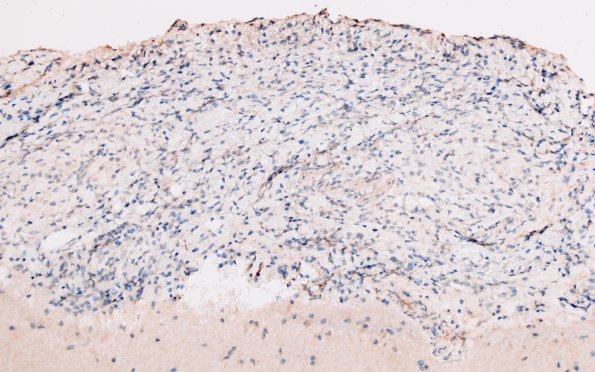 1G3 Diffuse leptomeningeal glioneuronal tumor (Case 1) IDH1 20X 1