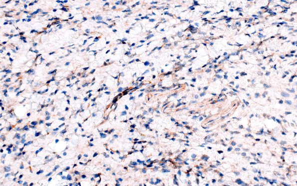 1G4 Diffuse leptomeningeal glioneuronal tumor (Case 1) IDH1 40X 1