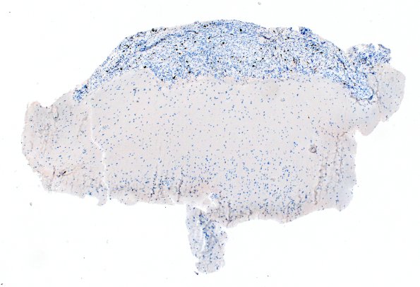 1H1 Diffuse leptomeningeal glioneuronal tumor (Case 1) Ki67 4X 2