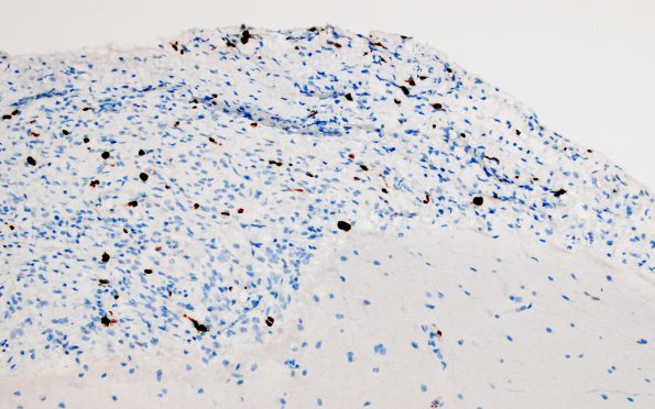 1H3 Diffuse leptomeningeal glioneuronal tumor (Case 1) Ki67 20X 1