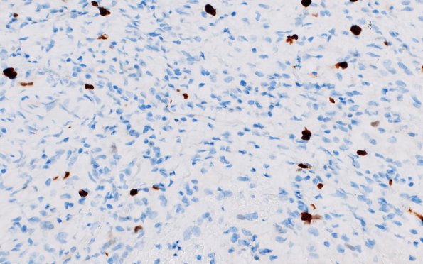 1H5 Diffuse leptomeningeal glioneuronal tumor (Case 1) Ki67 40X 1