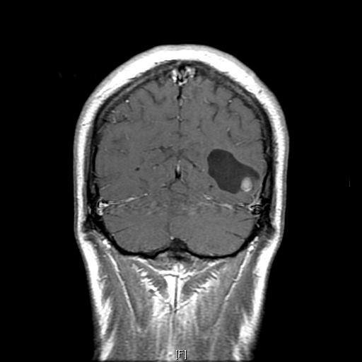 10A1 Ganglioglioma (Case 10) C,N_coronal_T1_postc3 - Copy