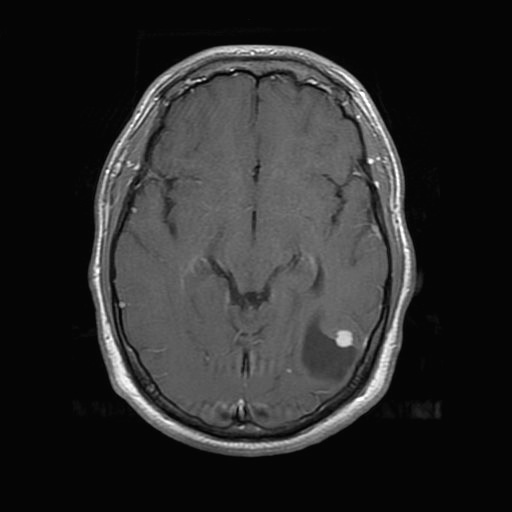 10A2 Ganglioglioma (Case 10) C,N_sagl_T1_postc2 - Copy