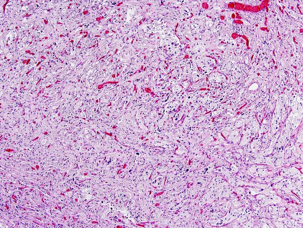 10C1 Ganglioglioma (Case 10) H&E 2.jpg