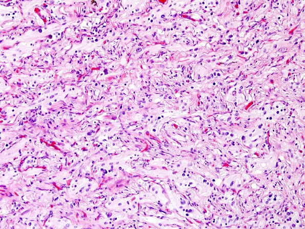 10C2 Ganglioglioma (Case 10) H&E 6.jpg