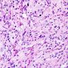 10C3 Ganglioglioma (Case 10) H&E 4.jpg