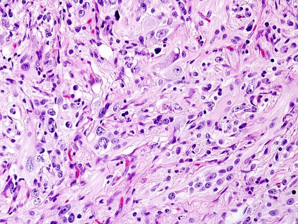 10C3 Ganglioglioma (Case 10) H&E 4.jpg