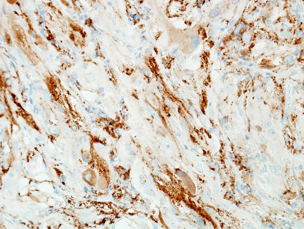 10D Ganglioglioma (Case 10) SYN 6.jpg