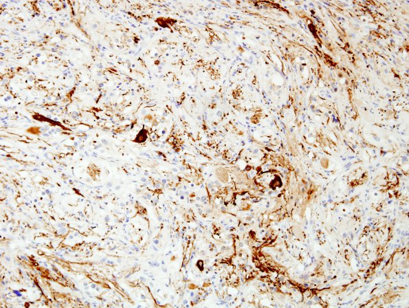 10E1 Ganglioglioma (Case 10) NF 4.jpg