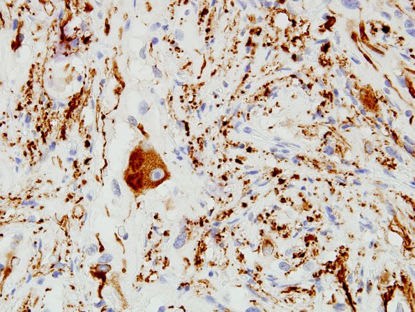 10E2 Ganglioglioma (Case 10) NF 8.jpg