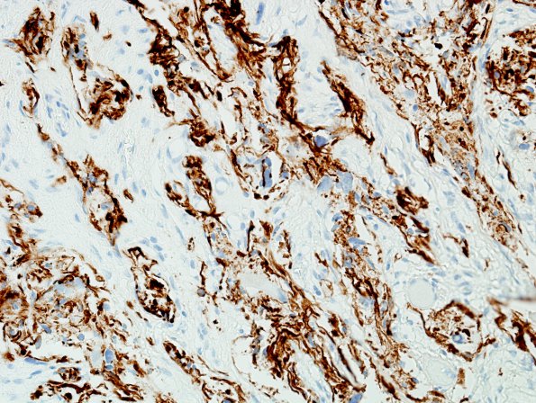 10F1 Ganglioglioma (Case 10) GFAP 4.jpg