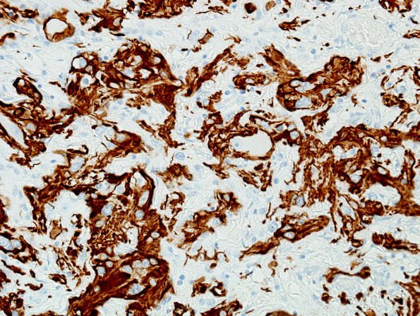 10F2 Ganglioglioma (Case 10) Ramified cells GFAP 1.jpg