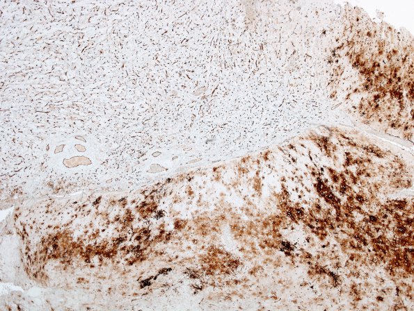 10G1 Ganglioglioma (Case 10) Ramified cells CD34 4X 2.jpg