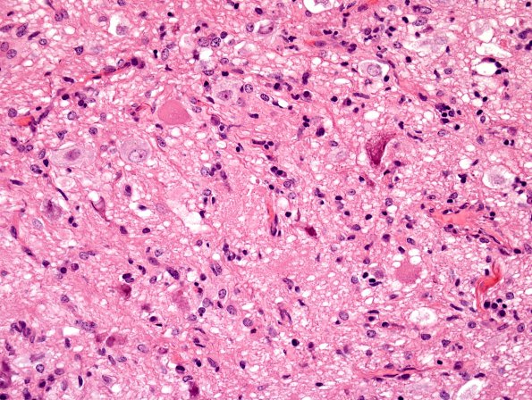 11A1 Ganglioglioma (Case 11) H&E 4.jpg