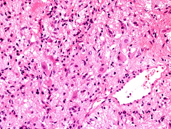 11A2 Ganglioglioma (Case 11) H&E 3.jpg