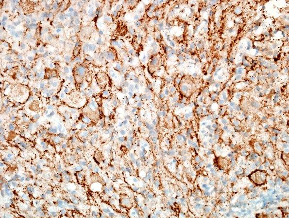 11B Ganglioglioma (Case 11) SYN 2.jpg