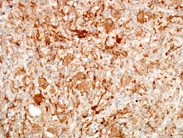 11C Ganglioglioma (Case 11) BRAF 2.jpg