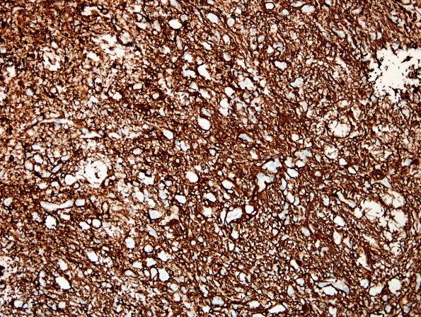 11D Ganglioglioma (Case 11) GFAP.jpg