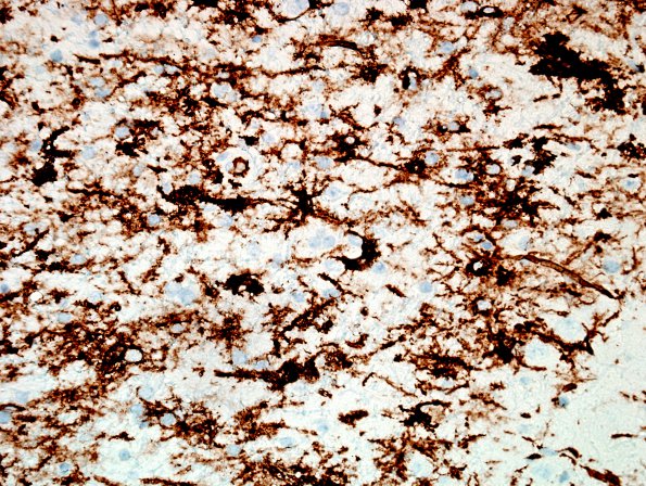 11E Ganglioglioma (Case 11) CD34 5.jpg