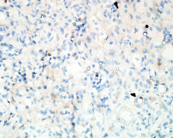 11F Ganglioglioma (Case 11) Ki67 1.jpg