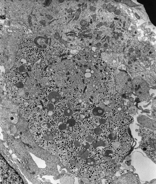 12A1 Ganglioglioma (Case 12A) EM 4 - Copy