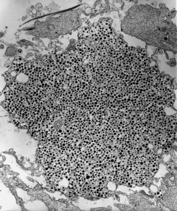 12A2 Ganglioglioma (Case 12A) EM 5 - Copy