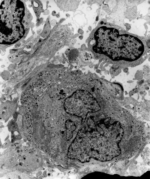 12A3 Ganglioglioma (Case 12A) EM 7 - Copy