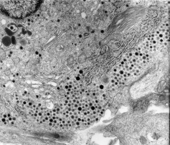 12A4 Ganglioglioma (Case 12A) EM 1 - Copy