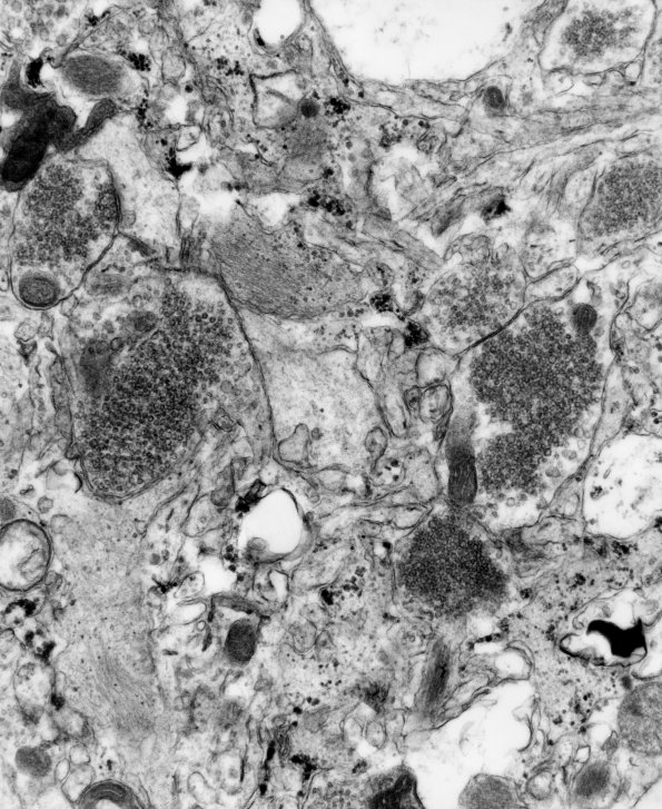 12B1 Ganglioglioma (Case 12B) EM 1 - Copy