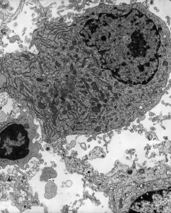 12B2 Ganglioglioma (Case 12B) EM 2 - Copy