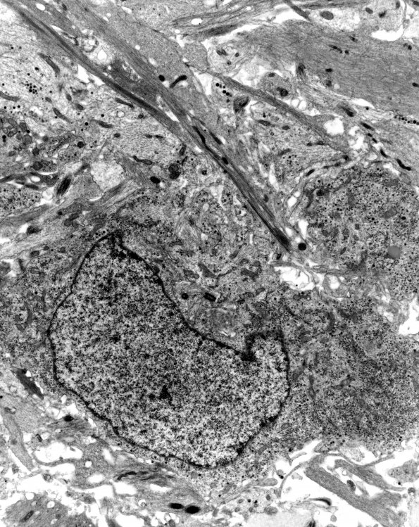 12C1 Ganglioglioma (Case 12C) EM 2 - Copy