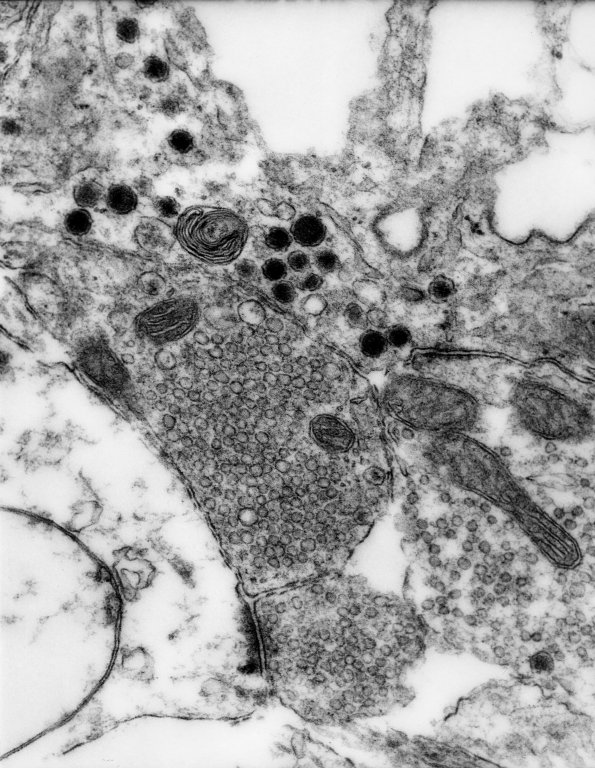 12C2 Ganglioglioma (Case 12C) EM 1 - Copy