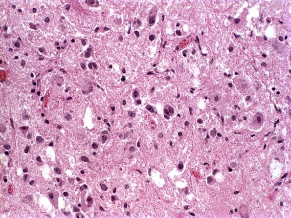 13A1 Ganglioglioma (Case 13) H&E 1