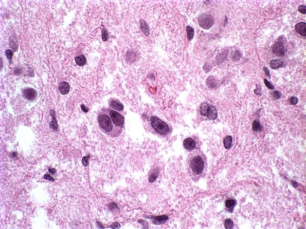 13A2 Ganglioglioma (Case 13) H&E 3