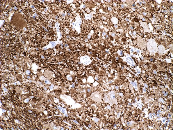 13B Ganglioglioma (Case 13) Synaptophysin