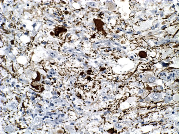 13C Ganglioglioma (Case 13) NFil