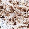 13D Ganglioglioma (Case 13) Chromogranin A