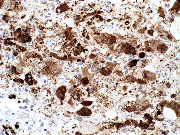 13D Ganglioglioma (Case 13) Chromogranin A