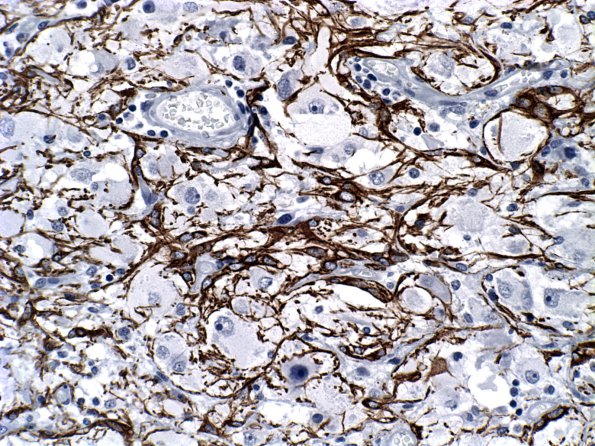 13F1 Ganglioglioma (Case 13) GFAP