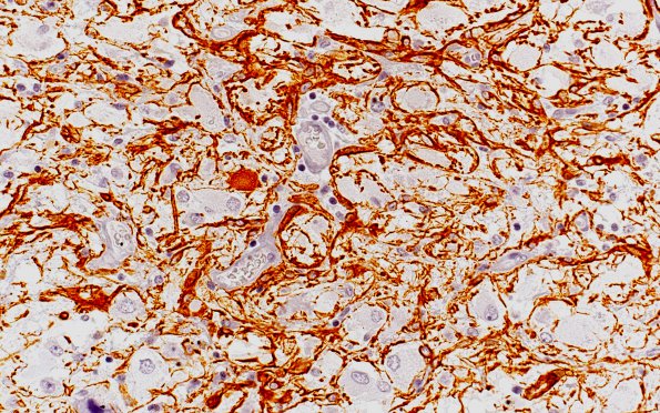 13F2 Ganglioglioma (Case 13) GFAP 40X