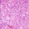 14A1 Ganglioglioma (Case 14) H&E 5